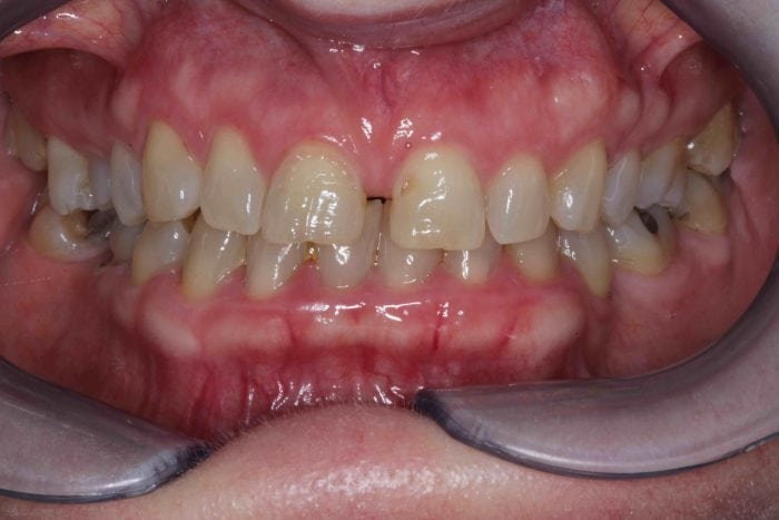 Before And After Dental Bonding Photos Cosmetic Bonding Dentists