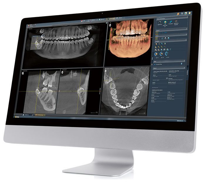 Dental Implants Process steps