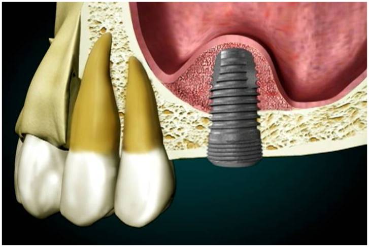 Dental Implants sinus grafting