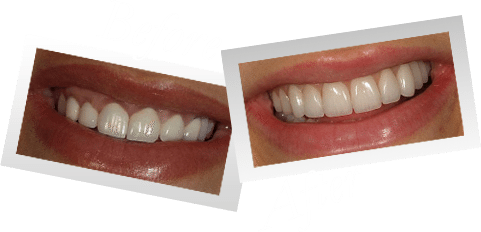 Smile Makeover Preston - Before and After