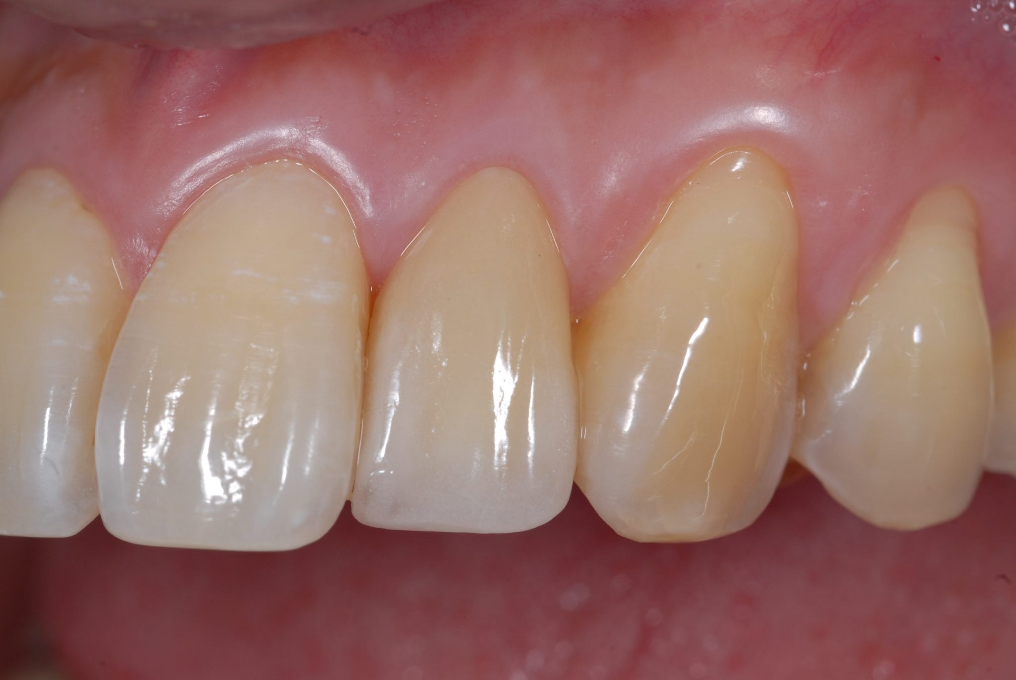 cosmetic dental crown - after