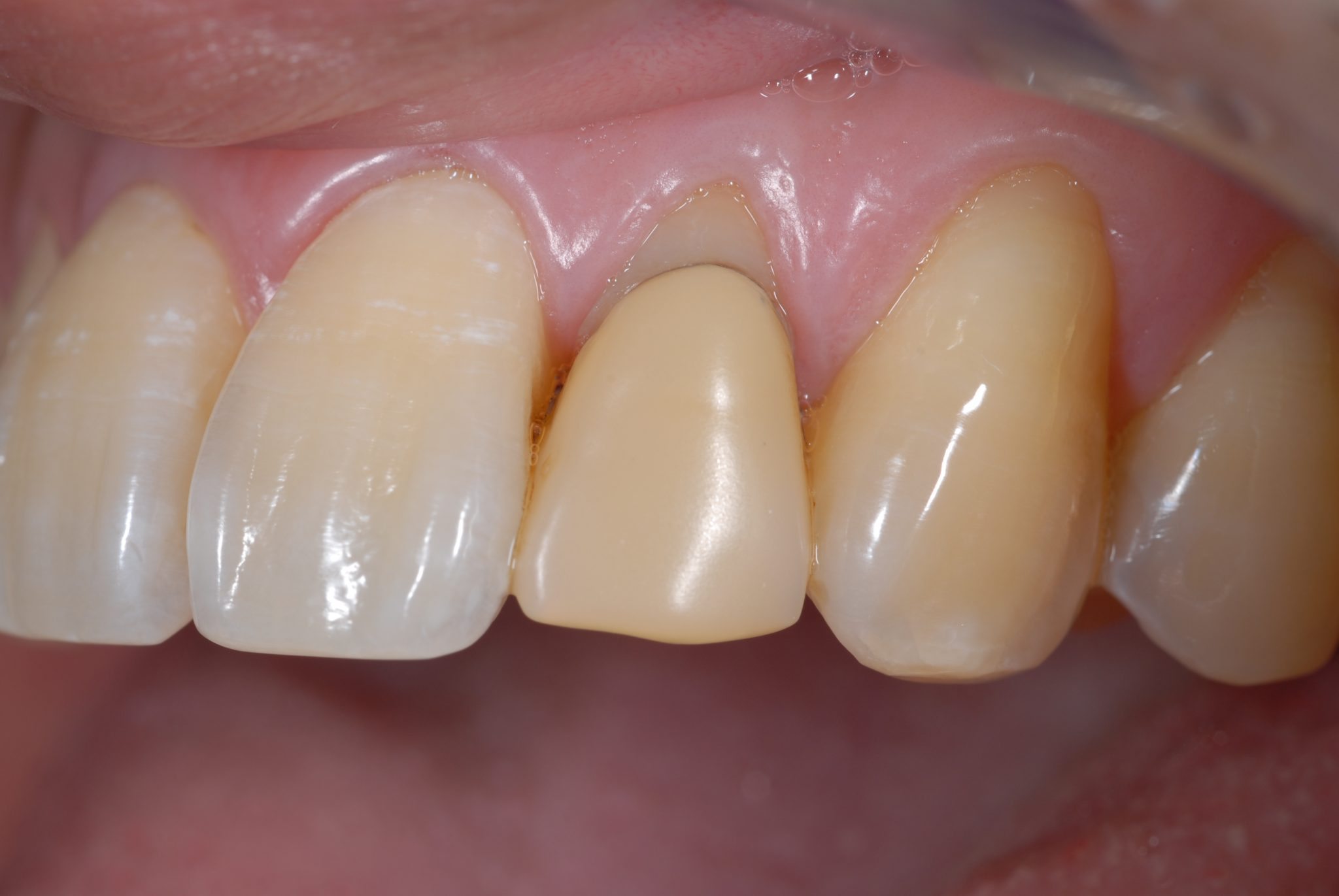 cosmetic dental crown - before