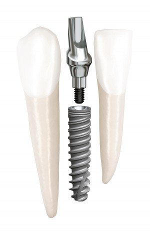Replace a Missing front tooth with a Single Dental Implant