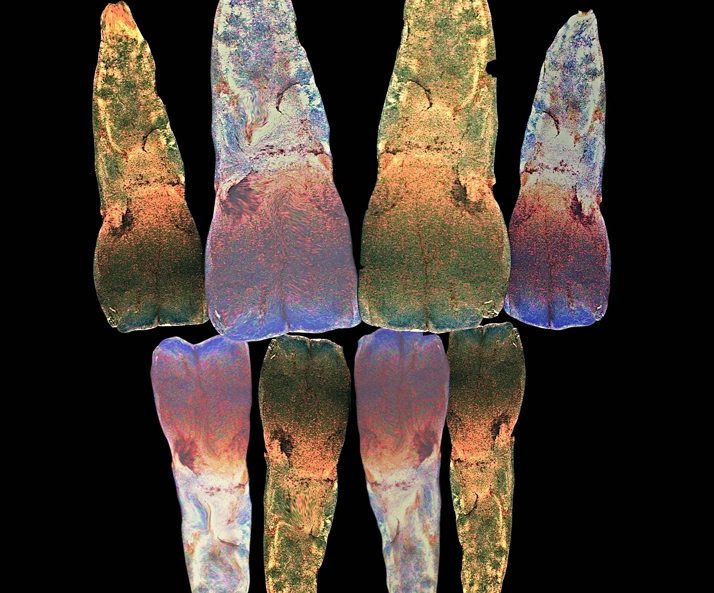 Discoloured Teeth Whitened with Bleaching