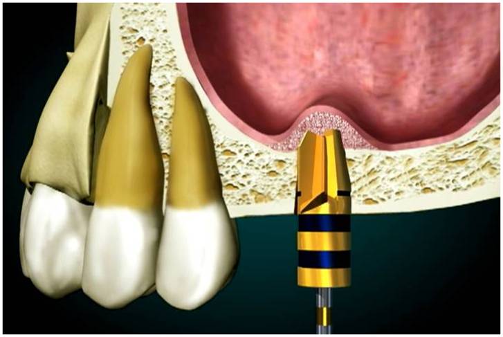 Dental implants sinus lift