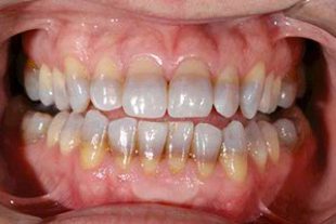 Discoloured and stained teeth treated with Porcelain Veneers - Lane Ends Dental Practice