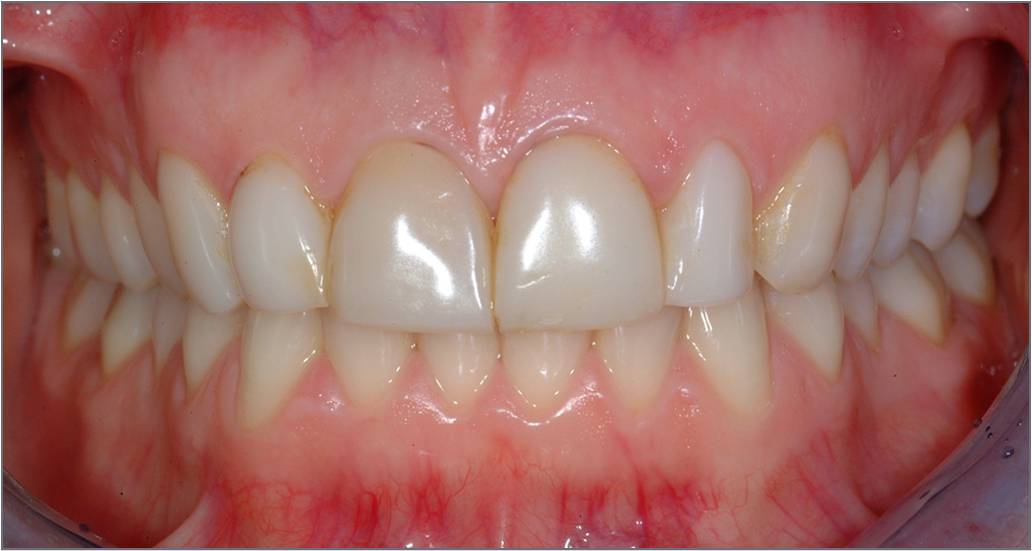 porcelain Veneers Smile MakeOver Before Pictures 
