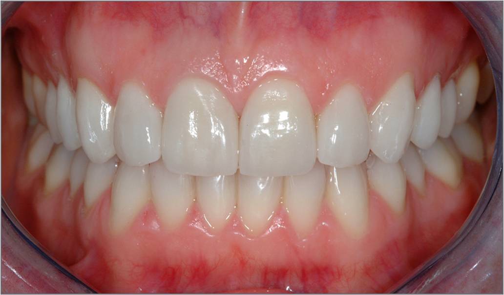 Porcelain Veneers Smile MakeOver After Photos