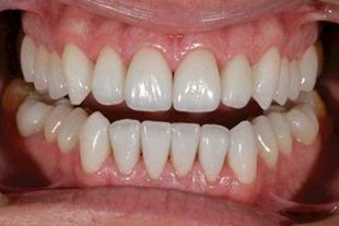 full porcelain tooth veneer treatment - final result