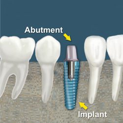 price - dental - implants