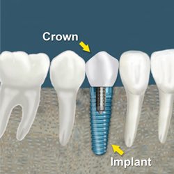 dental implants crown fee