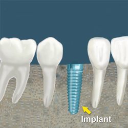 dental implant procedure costs and fees