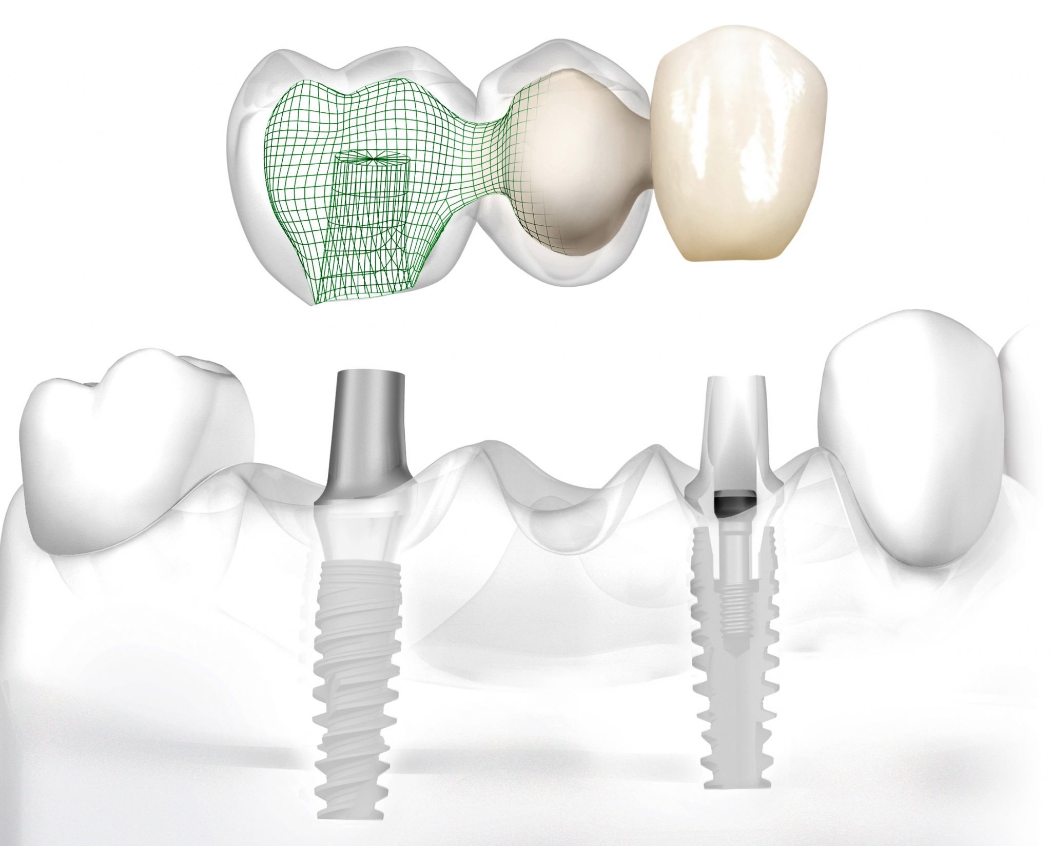 Options for replacing missing teeth