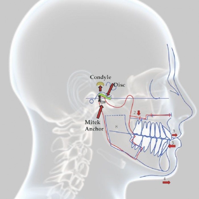 TMJ Treatment, Causes