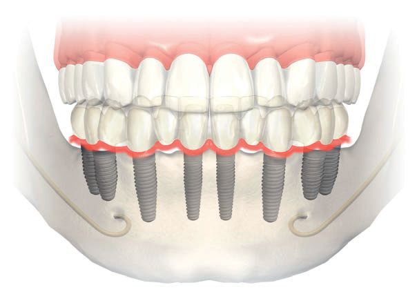 Replacement Teeth - Dental Implants - Dental Guide