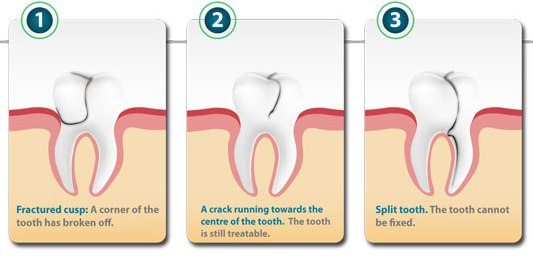 Chipped , Broken or Cracked Tooth Treatment