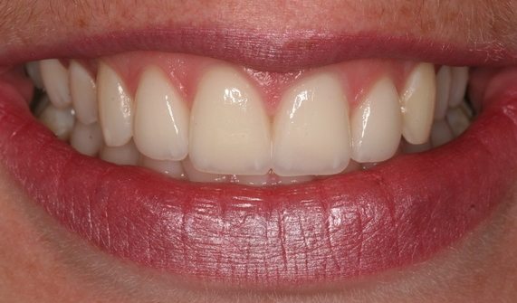 Gaps in Tooth Treatment