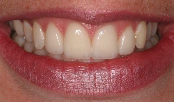 Closing Gaps in Teeth Cosmetic Dentistry Treatment ...