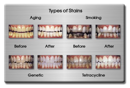 stained teeth treatment