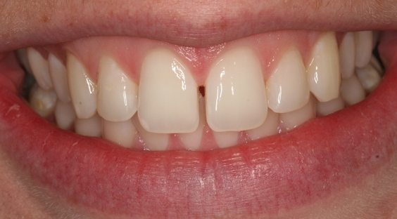 Fix Gap in Teeth