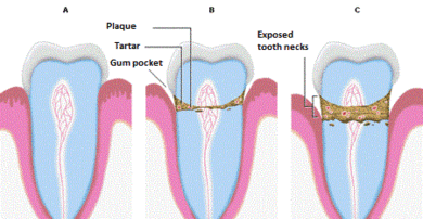 gingivitis - gum disease stages Bleeding gums Treatment