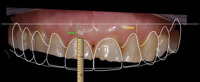 same day no prep veneers before after phtos