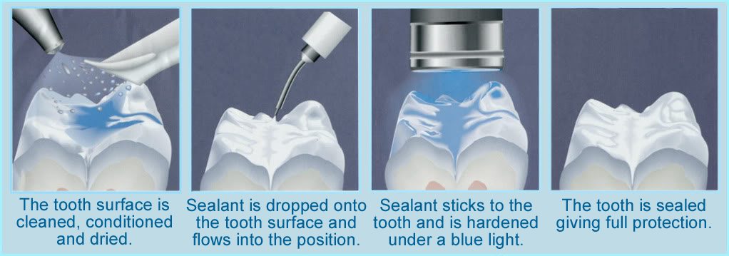 dental sealants use