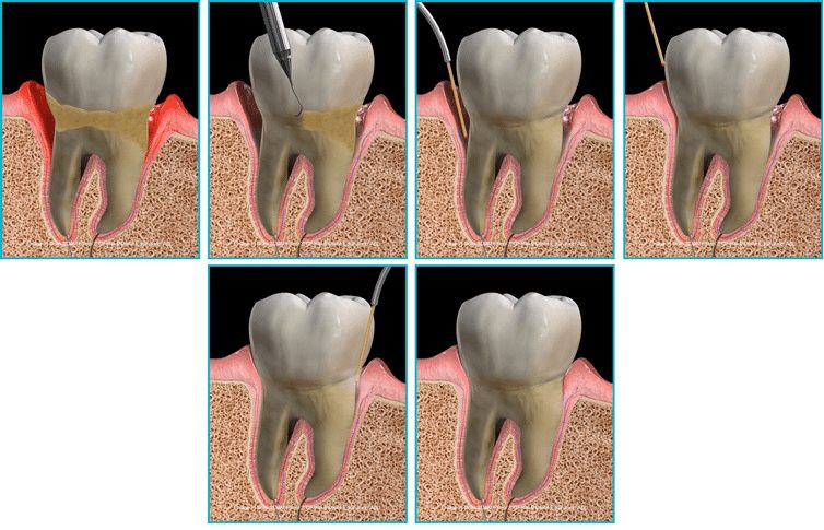 gum disease full mouth treatment