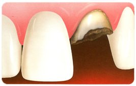 fractured tooth treatment with dental implants and bone grafting