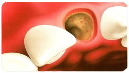 socket preservation after tooth extraction