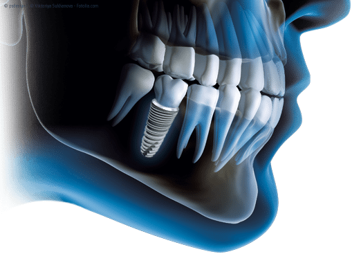 dental implant bone grafting - missing teeth replacement options