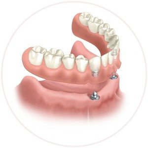 secured implant denture