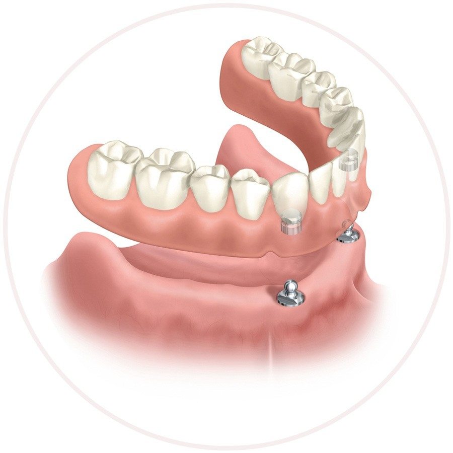 Denture implants replacing Missing Teeth