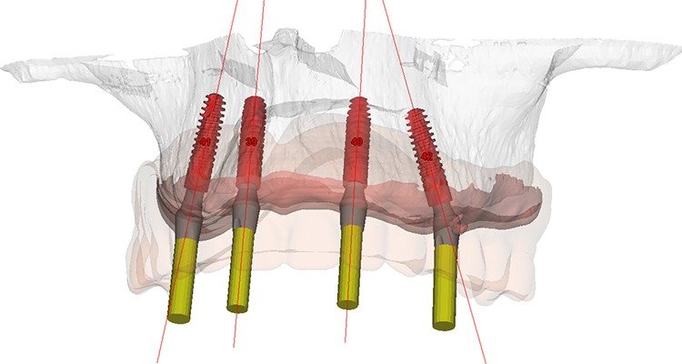 Dental Implants Clinic ; Teeth in an Hour Dental Implants