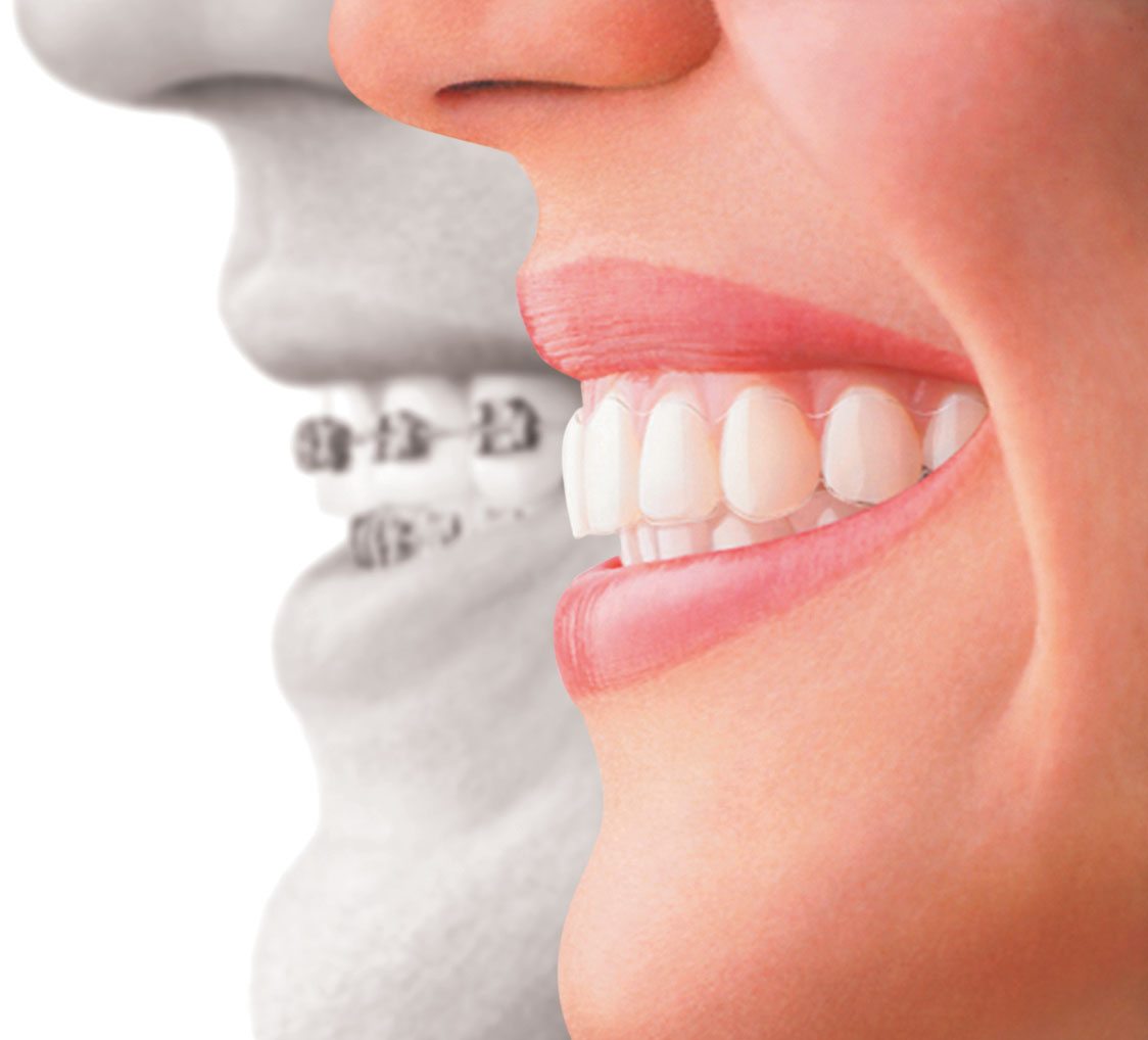 Orthodontic Treatment for Crooked Teeth 