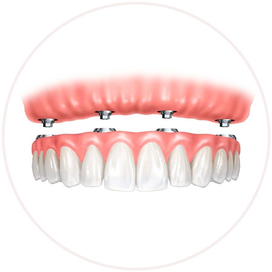 implant denture teeth