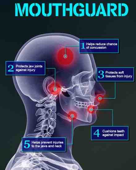 7 Facts About Your Sports Mouth Guard