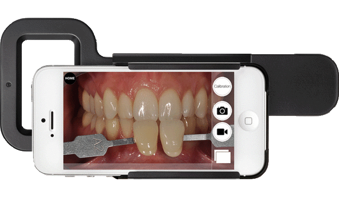 Dental Implants Process - Implant Crown