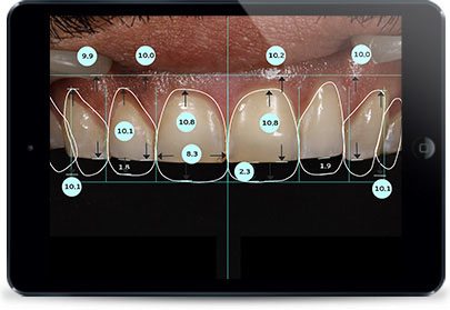 Tooth Crowns