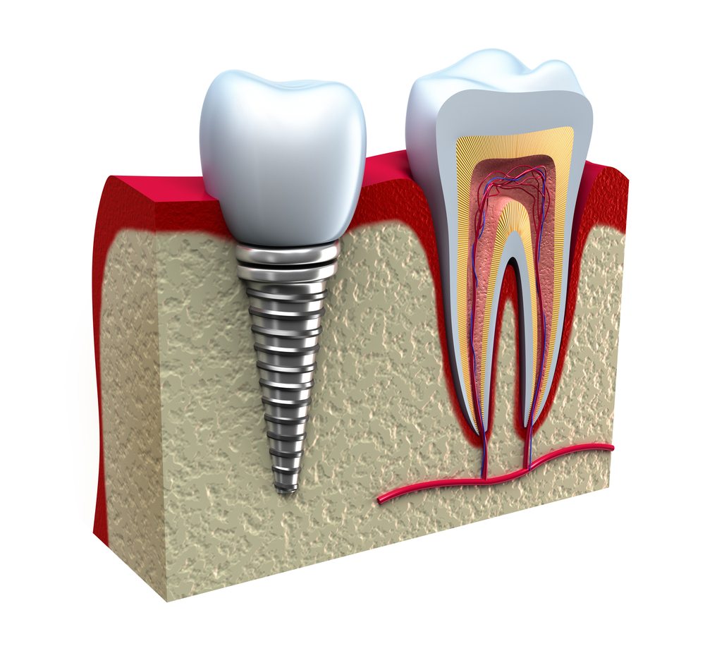 Dental Implant Practice , UK