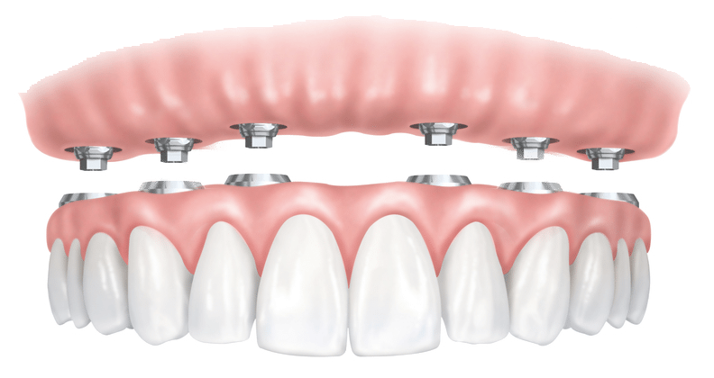 Dental Implants Clinic