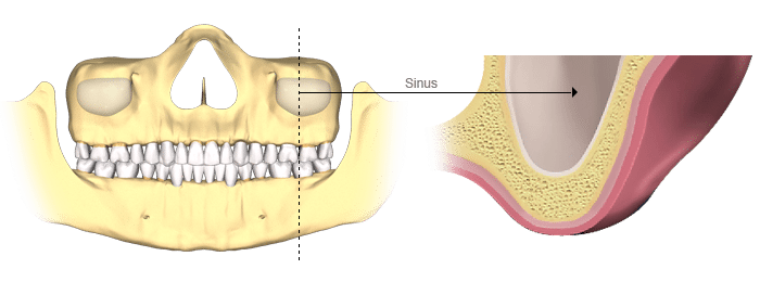 Sinus lift