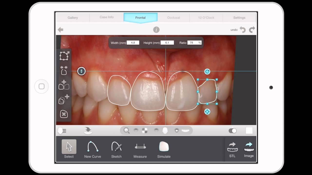 Digitally Designing Smile