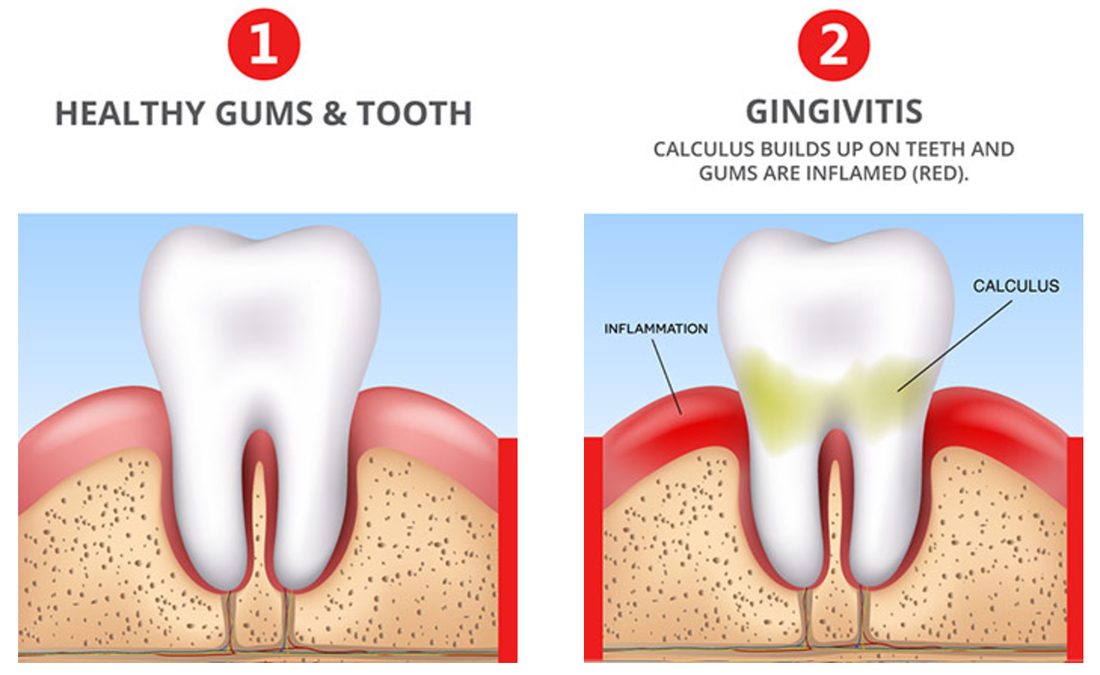 Gingivitis - Symptoms and causes