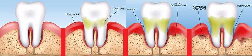 Does Oral Health Affect Your Bones? The Link Between Periodontitis and  Osteoporosis