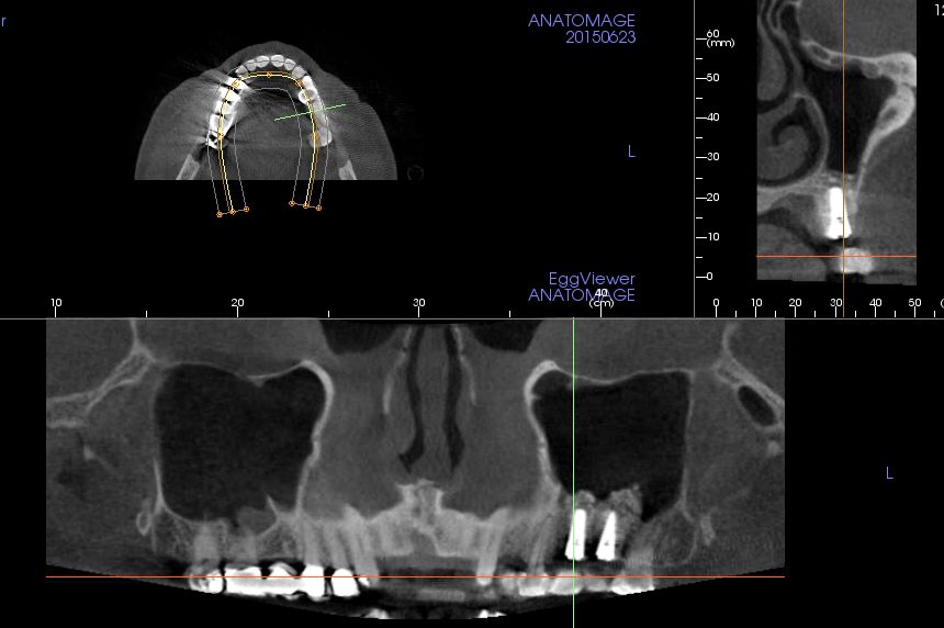 Missing Teeth Treatment