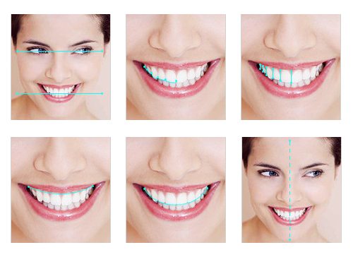 Principles Of Digital Smile Design