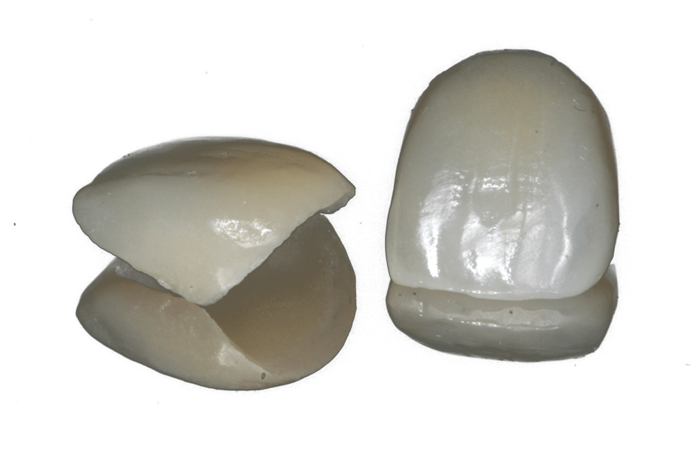 porcelain crowns in Preston