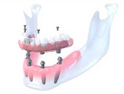 Full mouth dental implants