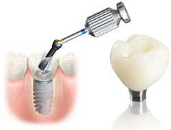 Single missing Tooth Treatment